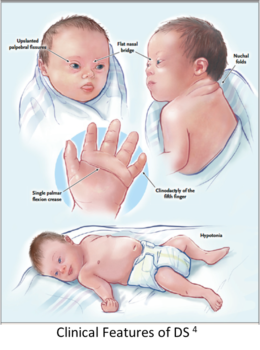 21 trisomy Trisomy 21: